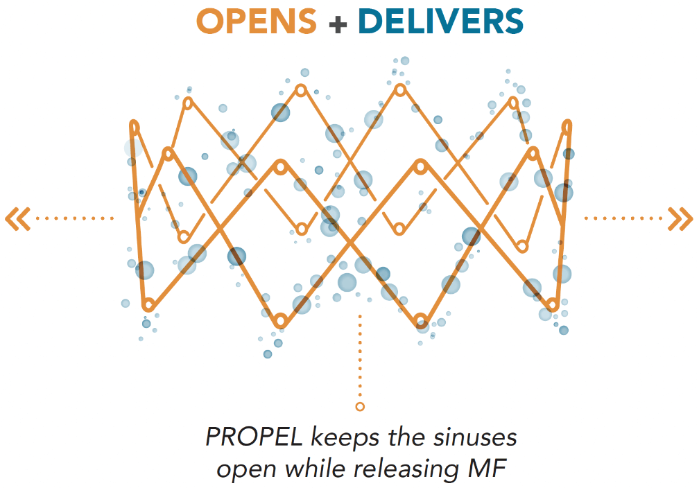 3D visual sketch of PROPEL opening up sinuses